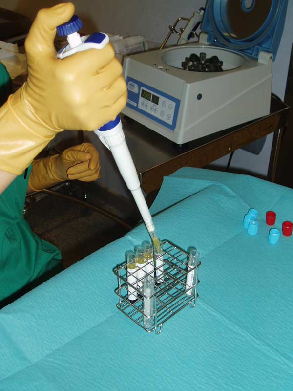 PLASMA RICO EN PLAQUETAS (P.R.P.)